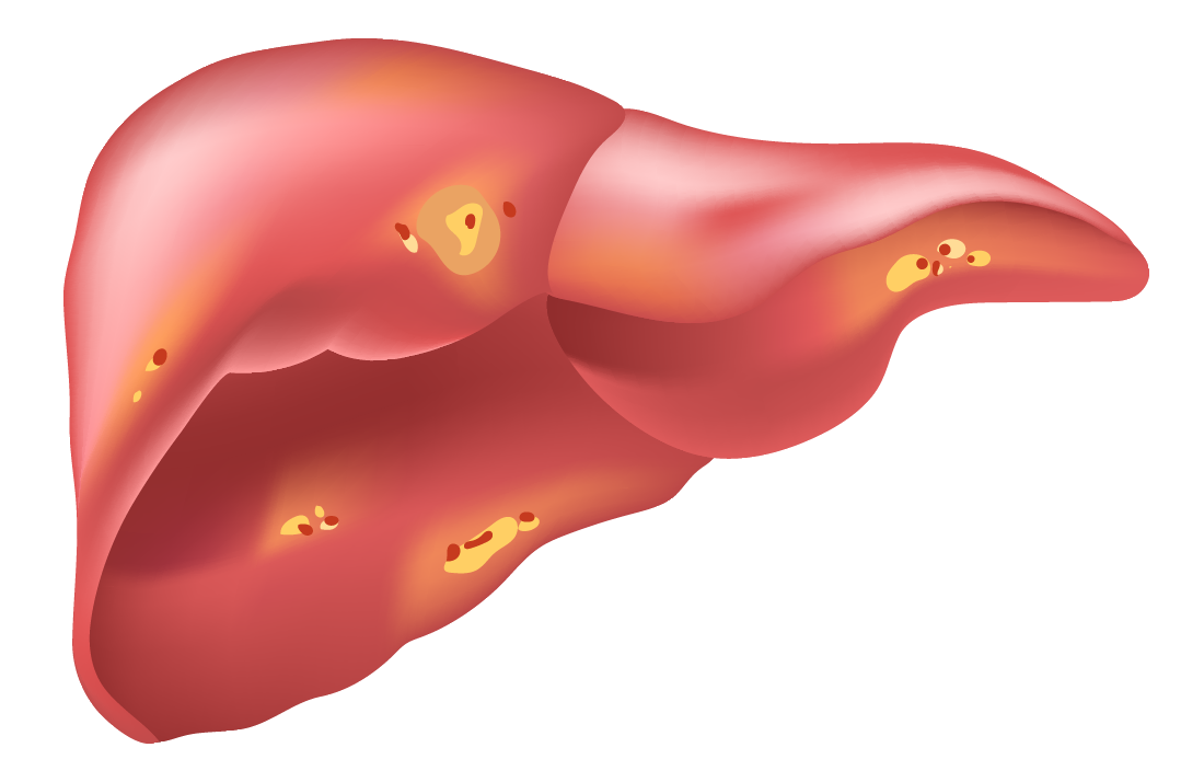 Steatoză hepatică