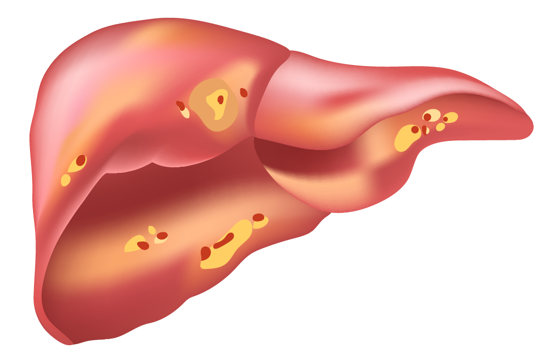 Steatohepatită MASH